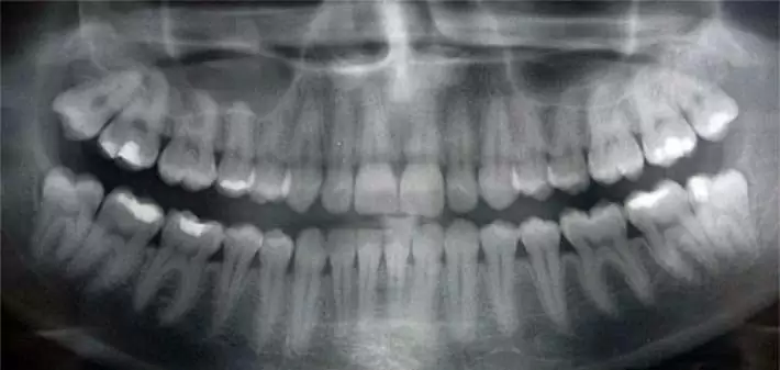 Panoramic X-Ray